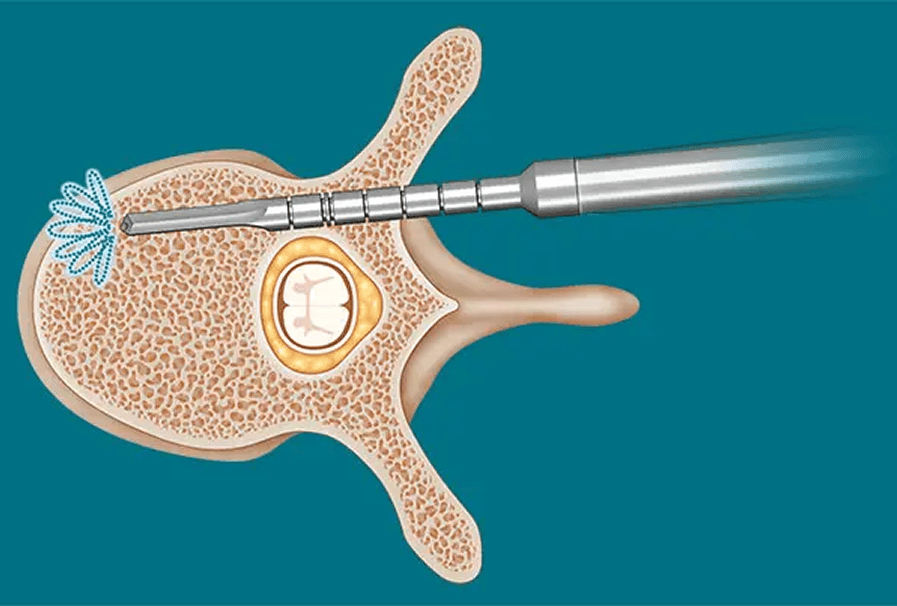 Portafolio SpineGuard en MedRent