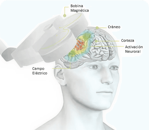 Estimulación magnética transcraneal (TMS)
