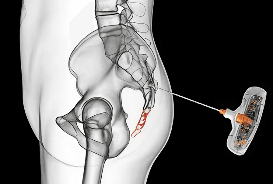 Guía dinámica para colocación pedicular
