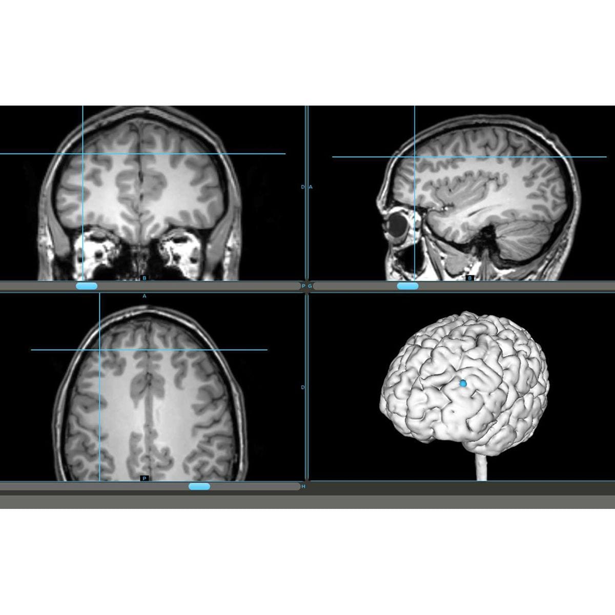 Syneika One - Neuronavegador TMS clínico